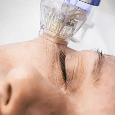 IPL Laser