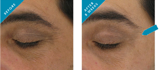 AOX+ Eye Gel - Mejora Clinica