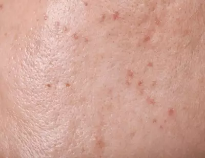 Piel con imperfecciones