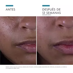 Antes vs Despues de Silymarin CF | SkinCeuticals Mexico