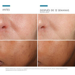 Antes vs Despues de Phloretin CF | SkinCeuticals Mexico