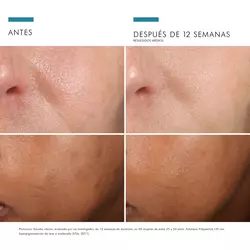 Antes vs Despues de Phloretin CF | SkinCeuticals Mexico