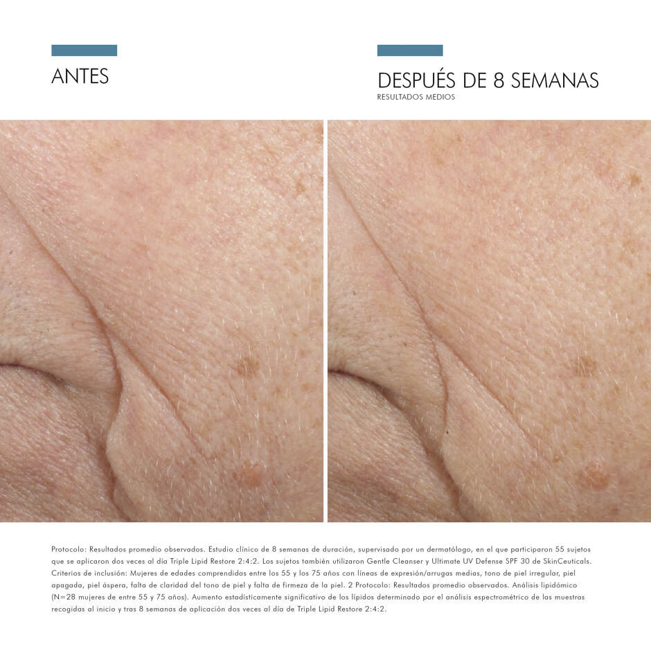 Antes vs Despues de Triple Lipid Restore 2:4:2 | SkinCeuticals Mexico