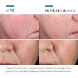 Antes vs Despues de Phyto Corrective Essence Mist | SkinCeutical Mexico