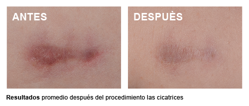 Scar Control - Promedio después del procedimiento las cicatrices