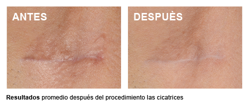 Scar Control - Promedio después del procedimiento las cicatrices