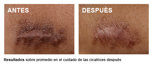 Scar Control - Promedio después del procedimiento las cicatrices